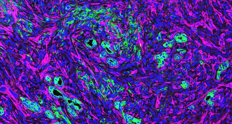 How drugs can target the thick &quot;scar tissue&quot; of pancreatic cancer