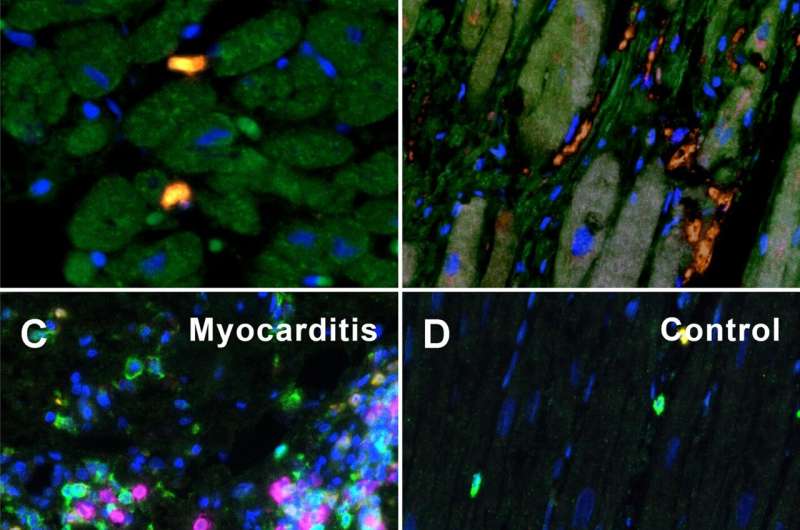 How inflammation in COVID 19 alters the smallest vessels in the heart