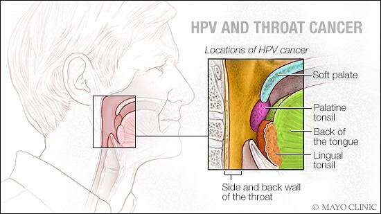 HPV infection may cause throat, mouth cancer