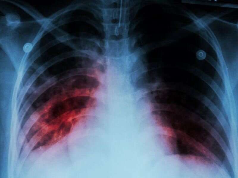 Incidence of tuberculosis up to 2.5 cases per 100,000 in U.S. in 2022