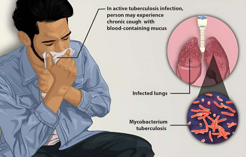 Indonesia needs to triple its funding to control tuberculosis—here's where to start
