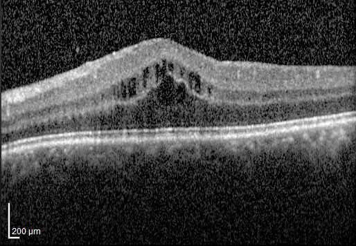 Intraocular corticosteroids best for treating complications of chronic inflammatory eye condition