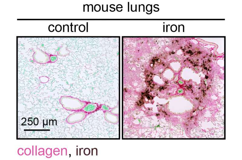 Iron accumulation: a new insight into fibrotic diseases