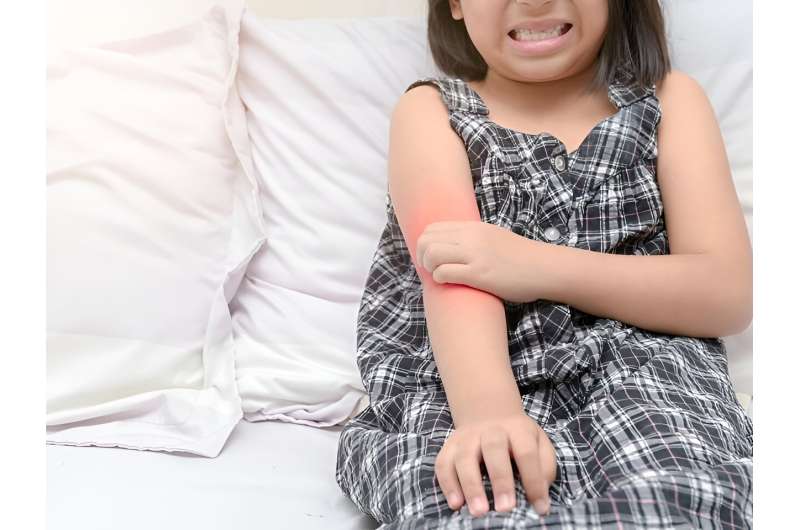 Kids with eczema may need further allergy tests