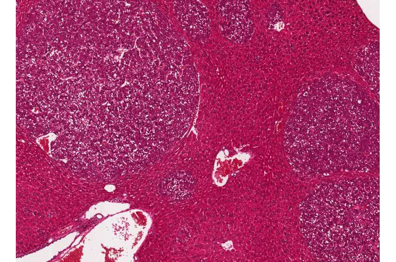 Liver cancer research: iron-dependent cell death could be the key to novel combination therapies
