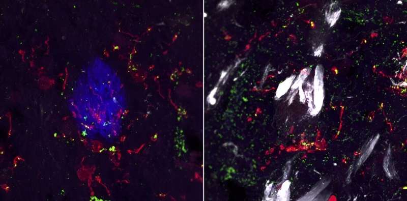 Marker for brain inflammation finally decoded