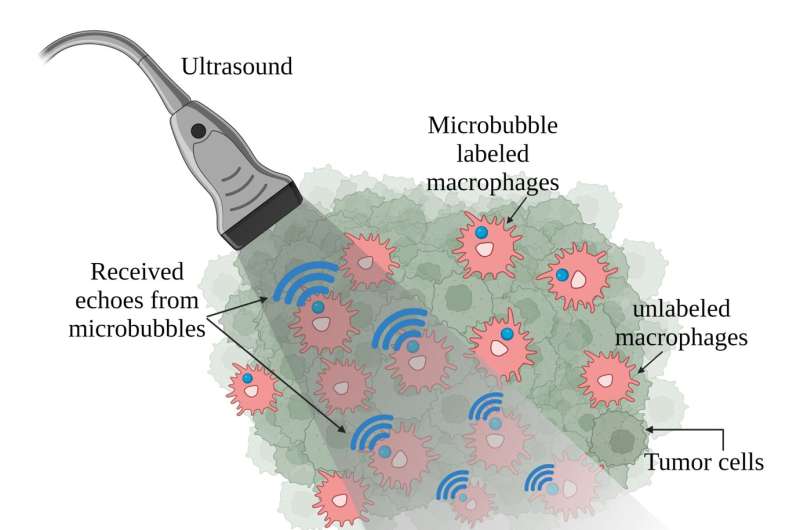 Microbubble macrophages track tumors #ASA184