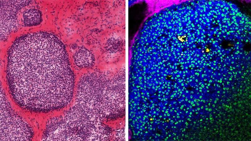 Microcalcification 'fingerprints' can yield info about cancer