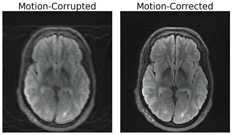 MIT researchers combine deep learning and physics to fix motion-corrupted MRI scans