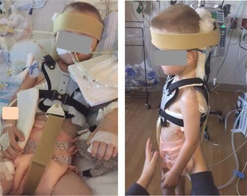 Modified Minerva orthosis proven helpful in pediatric patients following airway surgery