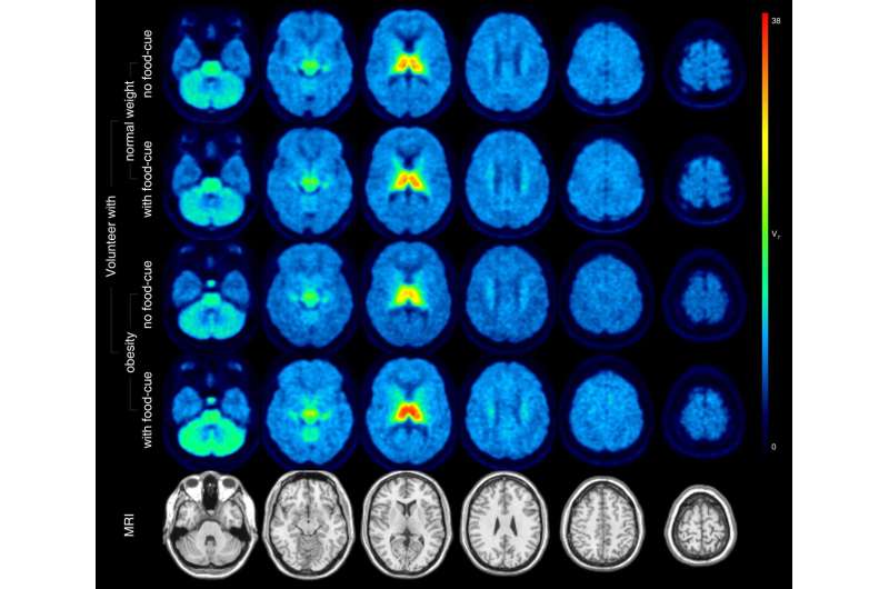 Molecular imaging identifies brain changes in response to food cues; offers insight into obesity interventions