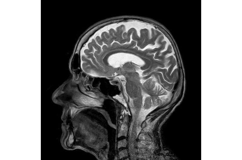 cérebro de ressonância magnética