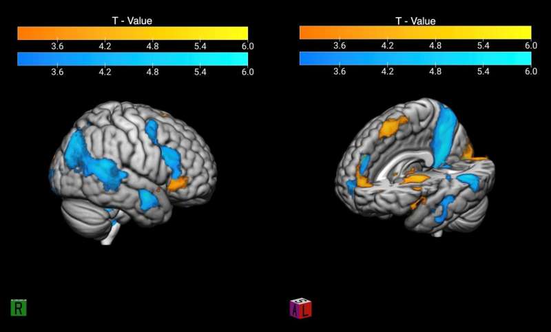 MRI reveals brain activity behind fanaticism