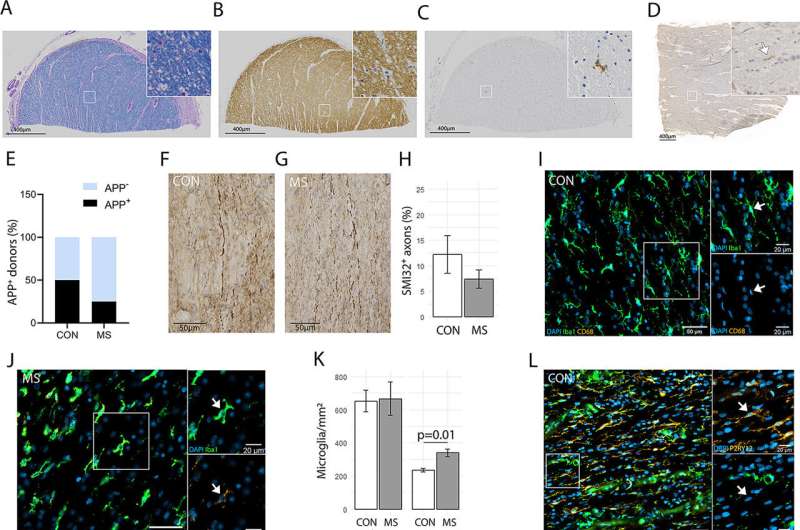 Esclerose múltipla: alterações ultraestruturais no tecido cerebral promovem processos inflamatórios