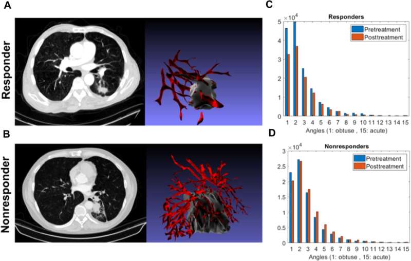 New AI-based biomarker can help predict immunotherapy response for patients with lung cancer