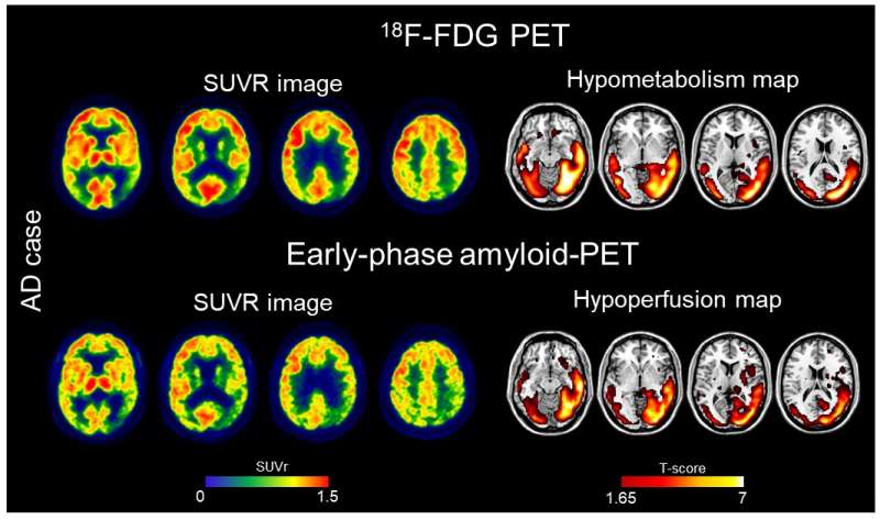 New dual-phase imaging protocol reduces costs and radiation exposure for cognitively impaired patients