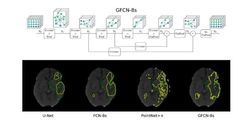 New geometric deep learning model for detecting stroke lesions