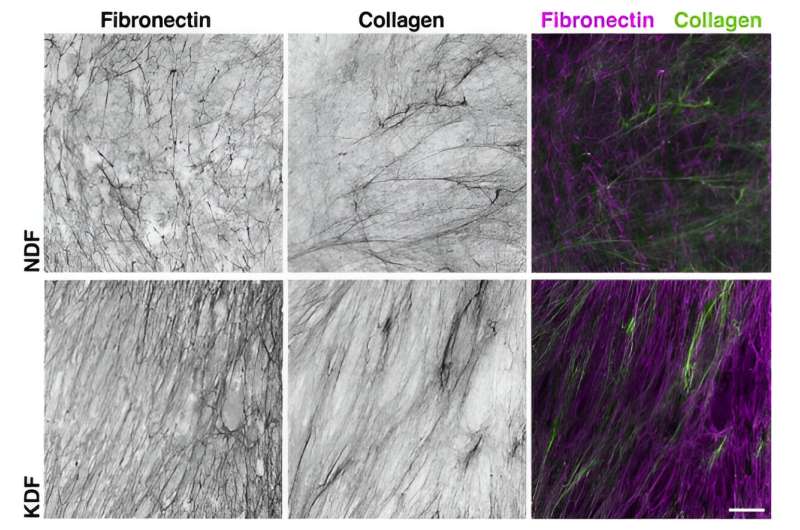 New insights from studying keloid scars could provide novel treatments for fibrosis