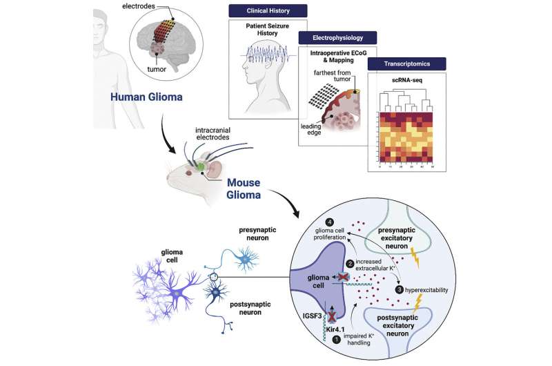 New insights into the drivers of glioma-related epilepsy