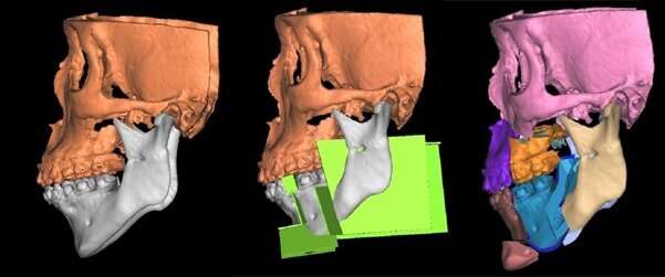 New jaw surgery concept effective in treatingmoderate-to-severe obstructive sleep apnea