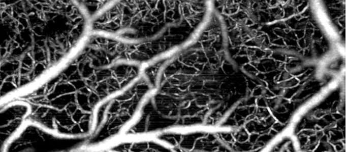 New method tracking changes in blood vessels could advance brain disease detection