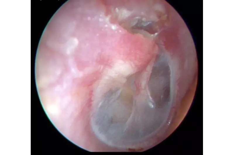 New research shows strong heredity component to middle ear cholesteatoma