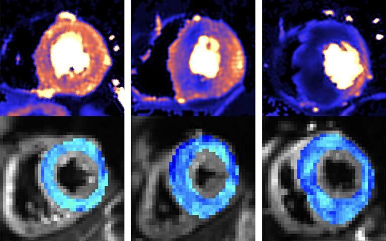 New scanning methods can detect deadly heart condition before symptoms appear