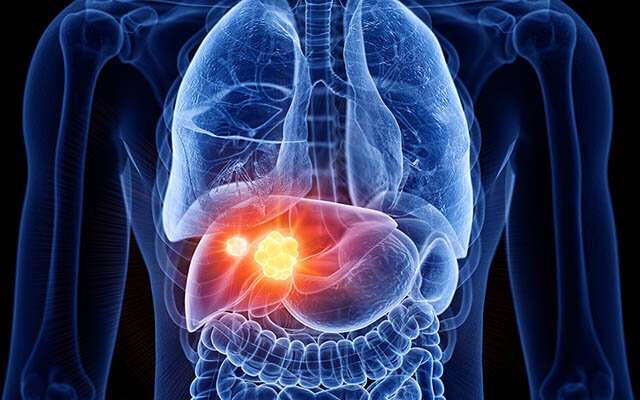 New study flips the script on liver cancer