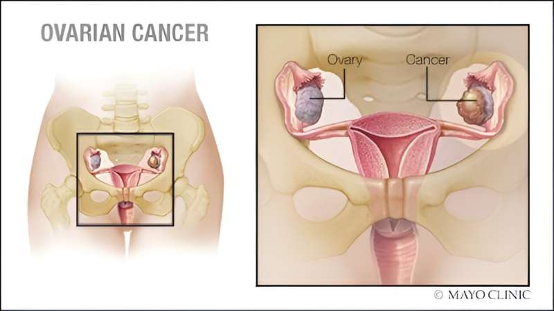 New surgical method for ovarian cancer lights up lesions