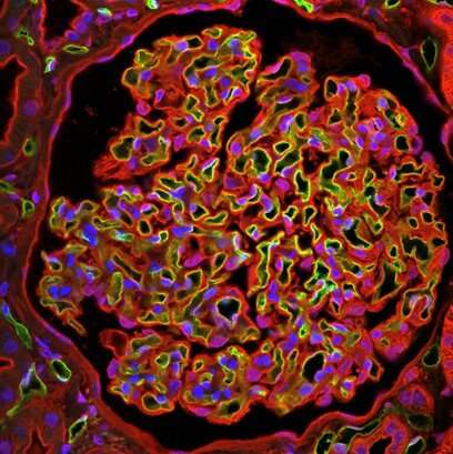New way to reduce progression of diabetic kidney disease discovered