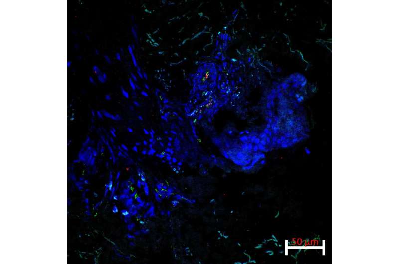 NIH researchers discover new autoinflammatory disease, suggest target for potential treatments