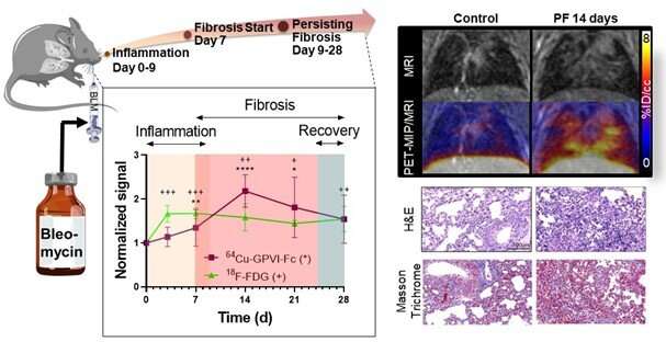 Novel imaging agent allows for earlier detection of progressive pulmonary fibrosis