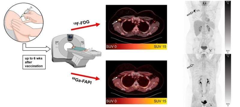 Novel PET radiotracer reduces number of false-positive cancer findings after COVID-19 vaccination