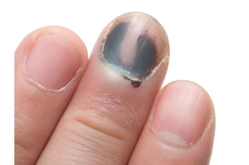 Ouch! you injured a nail: tips on best treatment