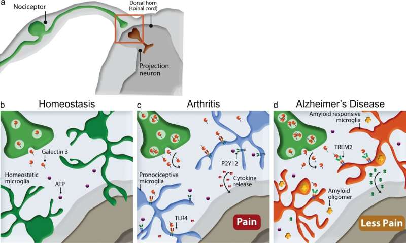 Pain not perceived in the same way in people with Alzheimer's disease