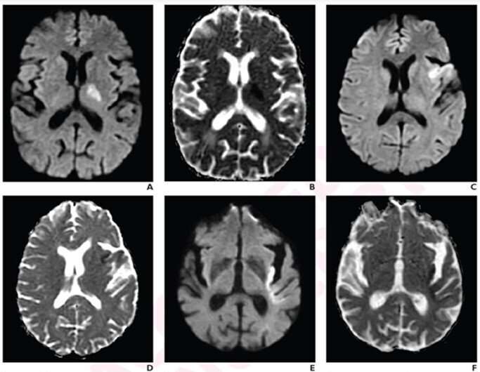 Percent insular ribbon infarction for growth rate prediction, outcomes in large-vessel occlusive stroke