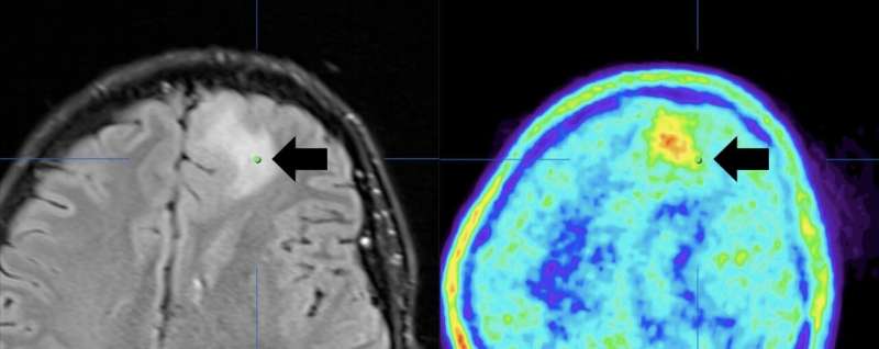 PET imaging: Aggressive brain tumors will soon be treated more effectively