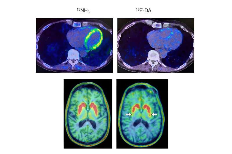 PET scans may predict Parkinson's disease and Lewy body dementia in at-risk individuals