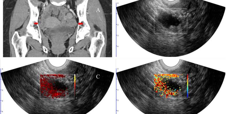 Photoacoustic imaging improves diagnostic accuracy of cancerous ovarian lesions