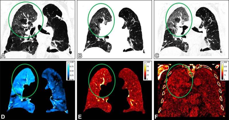Photon-counting CT can evaluate lung function