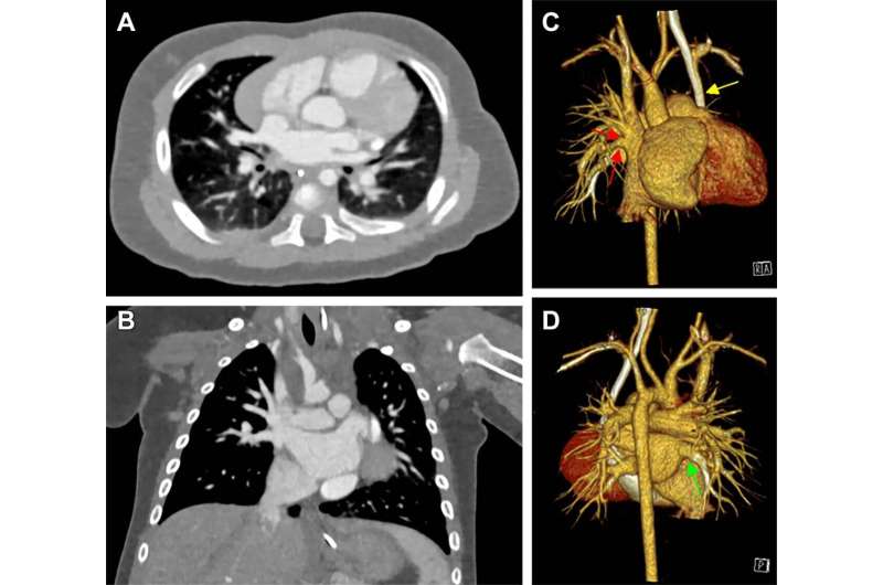 Photon-counting CT offers superior imaging in babies with heart defects