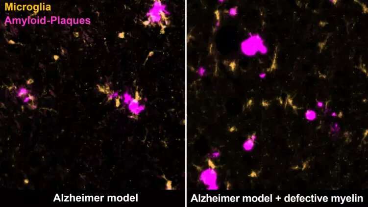 Poorly insulated nerve cells promote Alzheimer's disease in old age