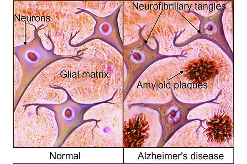 Radiologists must monitor novel Alzheimer's treatment side effect