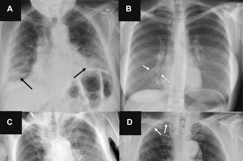 Radiologists outperformed AI in identifying lung diseases on chest X-ray