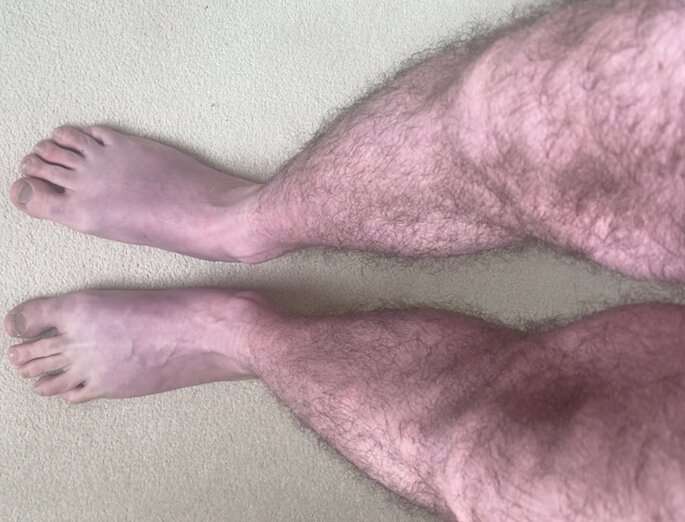 Raising awareness of Long Covid 'blue legs' symptom