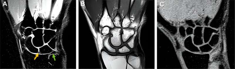 Real-time MRI captures wrists in motion