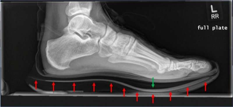 Recognizing the potential for bone stress injuries after using carbon fiber plate footwear