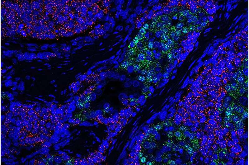 Researchers detail how prostate cancers grow more aggressively to evade treatment