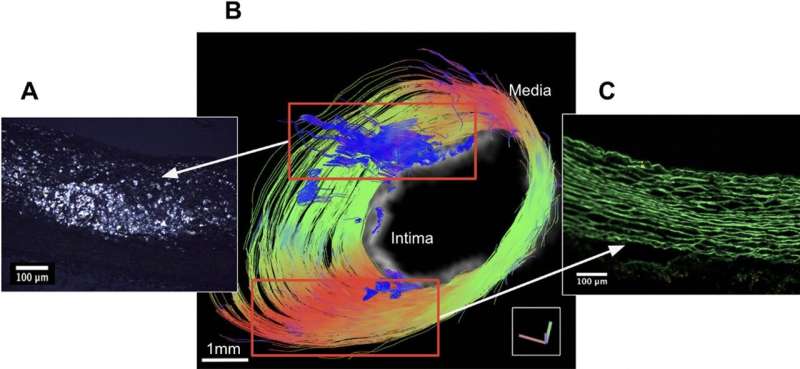 Researchers develop, validate tool to visualize 3D architectural properties of atherosclerosis plaques