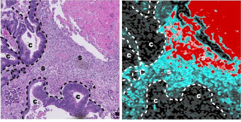 Researchers discover the mechanism by which tumor cells become resistant to chemotherapy in colorectal cancer